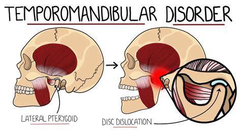 Temporomandibular Joint Disorder Explained (TMJ Dysfunction) | Includes ...