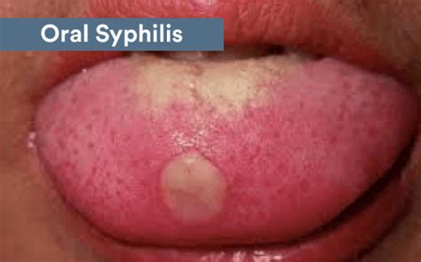 The full breakdown on Oral STDs: Types, symptoms, and treatment