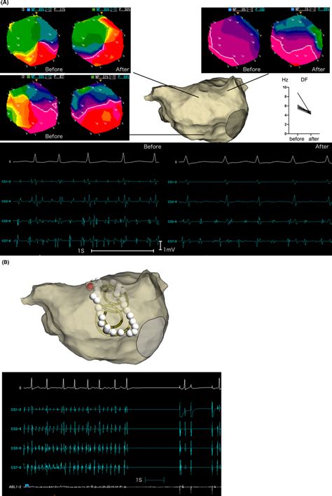 Persistent atrial fibrillation that lasted for 3 years in a 63‐year‐old... | Download Scientific ...