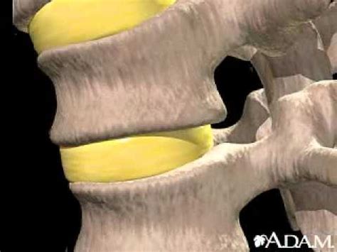 √ Hnp (Herniated Nucleus Pulposus) Lumbar