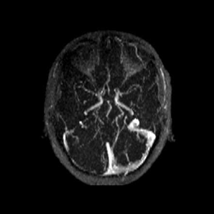 Hypoplastic transverse sinus | Radiology Case | Radiopaedia.org