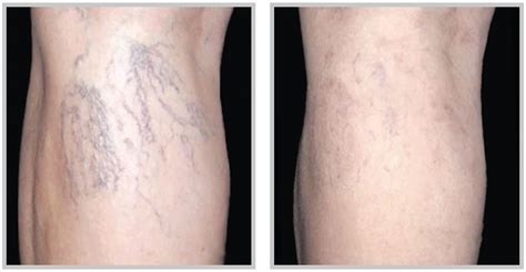 Spider Vein Removal Facial & Leg veins | Laser Creations