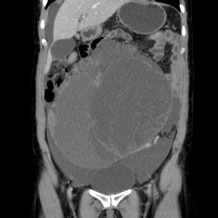 Mucinous Ovarian Cyst