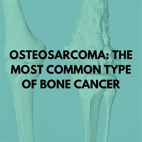 Osteosarcoma: the most common type of bone cancer