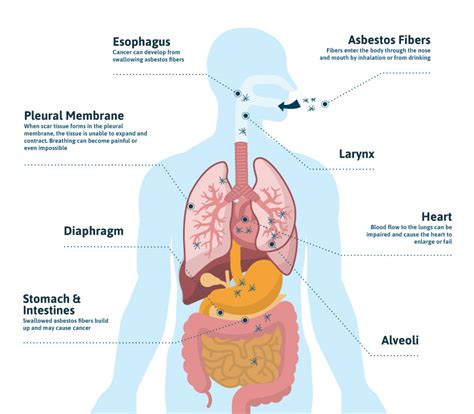 Mesothelioma Causes - Dangerous Asbestos Exposure Risks