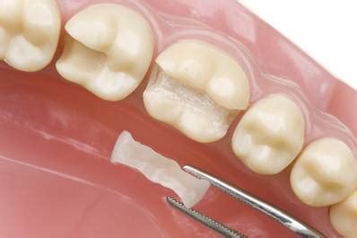 Tooth Cavity Filling: Cost and Step-by-Step Procedure | UtoDent.com