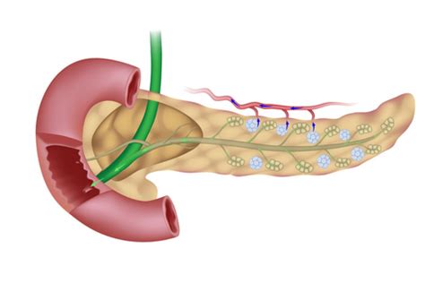 Pancreatic Enzyme Products May Benefit Cystic Fibrosis Patients with ...