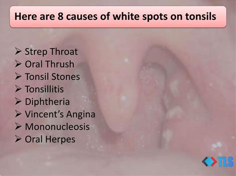 Sore Throat White Spots On Tonsils