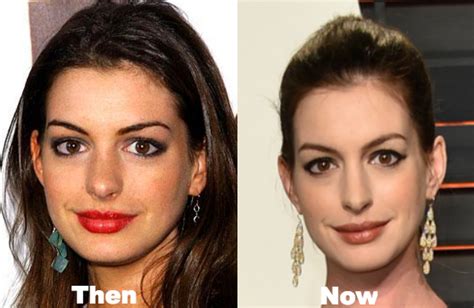 Anne Hathaway Plastic Surgery Before and After Photos