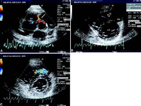 Double-Chambered Right Ventricle | Circulation