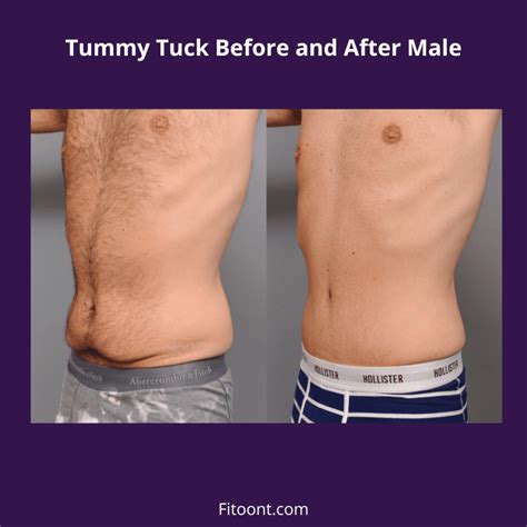 Tummy Tuck Before and After Male Tips and Recovery - Fitoont