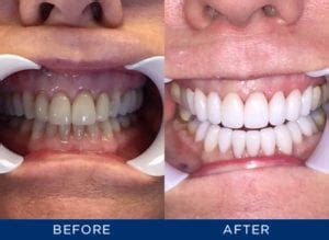 Porcelain Veneers vs. Teeth Whitening Pros & Cons