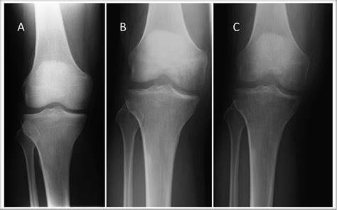 Knee Subchondral Stress Fracture