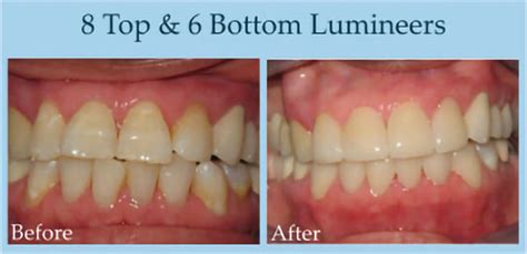 Lumineers and Veneers Before and After Gallery - Gentle Dentistry of San Diego & Poway