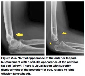 How to Approach the Pediatric Elbow EMRA