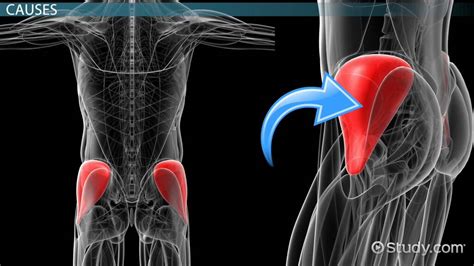 Gluteus Medius Tear | Symptoms, Diagnosis & Treatment - Lesson | Study.com