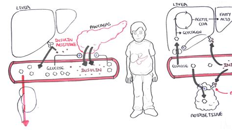 Type 2 Diabetes Pathophysiology Diagram