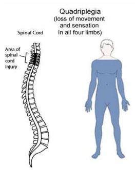 Quadriplegia: Cause, Symptoms, Physiotherapy Treatment and Exercise