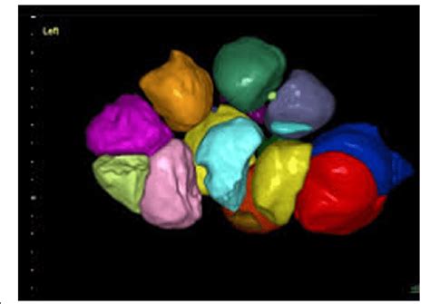 3D ultrasound's image to determine antral follicle count. Legend:... | Download Scientific Diagram