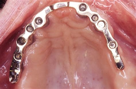 Implant Dentures (Complete)