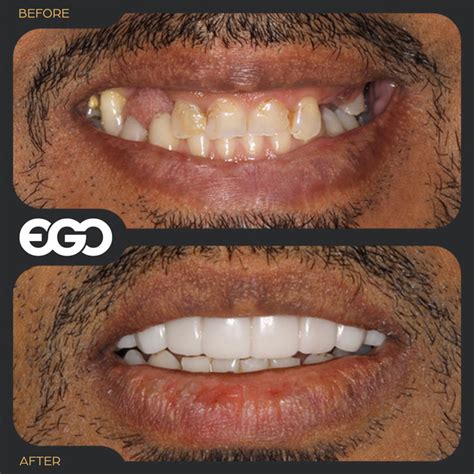 Snap On Smile – EGO Dental Clinic Westminster London