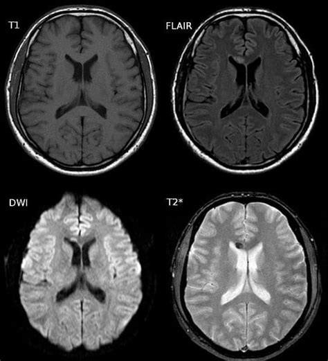 Diffuse Axonal Injury - Grading - Prognosis - TeachMeSurgery