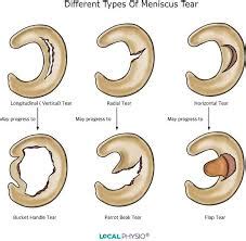 How to treat torn Meniscus ? – JointsGuru