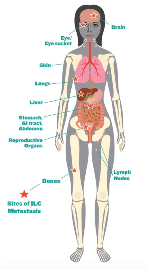 Factsheet: ILC - A Unique Subtype of Breast Cancer - The Lobular Breast Cancer Alliance