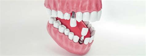 Cosmetic dentistry treatments: Types, procedures & cost