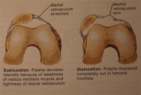 Image result for What causes patellar tracking disorder? | Patellar tracking disorder ...