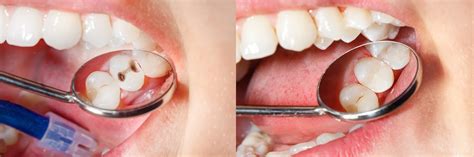 Composite Fillings | All You Need to Know About Materials and Treatment