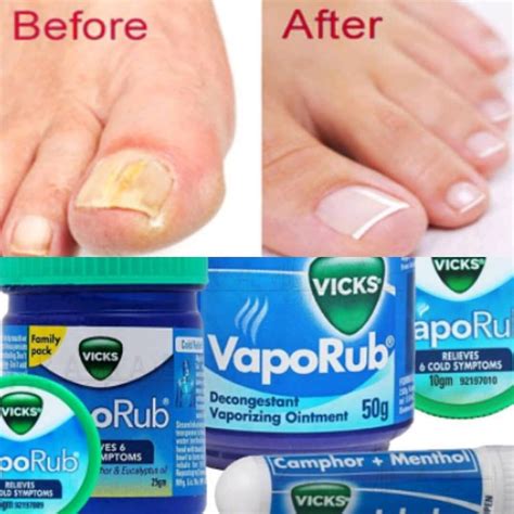 Vicks vaporub can clear up toenail fungus AND brittle discolored ...