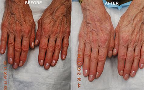 AGING HANDS BEFORE & AFTER PHOTOS