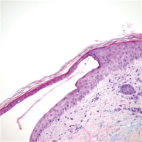 Serous and Hemorrhagic Bullae on the Leg | MDedge Dermatology