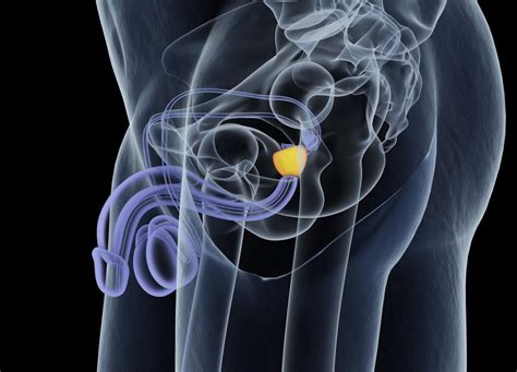 Prostate nodule: Causes, changes, and diagnosis