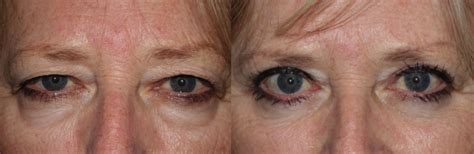 Upper-Blepharoplasty-Eyelid Lift-Pictures-4 - Dr. Guy Massry