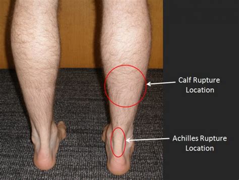 Calf Muscle Tear - FootEducation