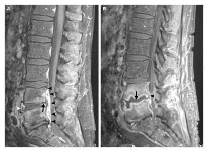 Osteomyelitis - Physiopedia