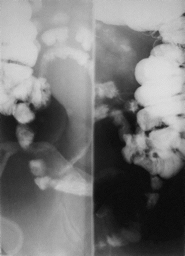 Combined terminal ileoscopy and biopsy is superior to small bowel ...