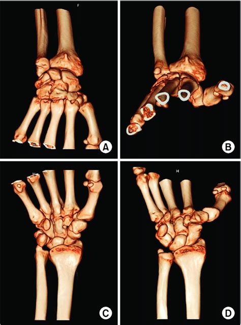 Locations of the ulnar styloid process in the wrist with the forearm... | Download Scientific ...