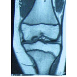 MRI revealed a 2 cm-long defect at the medial femoral condyle at the... | Download Scientific ...