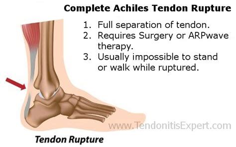 Torn Achilles Tendon, Heal Fast or Heal Slow After Achilles Tendon Surgery