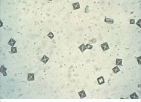 calcium oxalate (dihydrate) crystals | Medical laboratory, Calcium