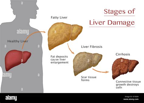 Stages of liver damage. Starting from a healthy liver (left), deposits ...