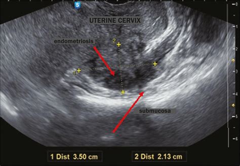 Endometriosis Transvaginal Ultrasound