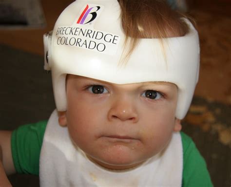 Is the Head Round? Baby helmets may help “Flat Head Syndrome” - BabyScience