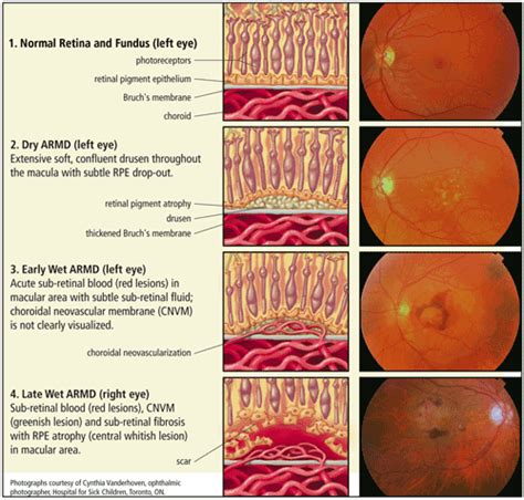 1000+ images about Age Related Macular Degeneration on Pinterest | An ...