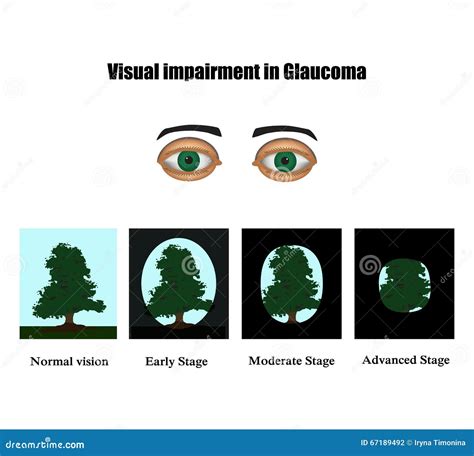 Glaucoma. The Field Of Vision In Glaucoma. Infographics. Vector Illustration On Background ...