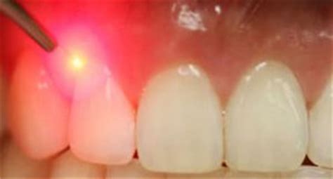 Laser Therapy Treatment for Periodontal Disease – Grateful Dental