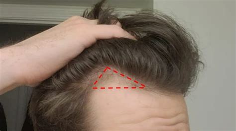 Norwood 2 Example Hairlines and Advice | BaldAndHappy.com